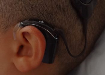 A Sassari il primo “orecchio bionico”