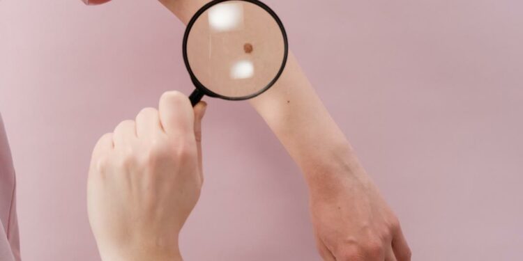 “Open day melanoma” all’Aou di Sassari