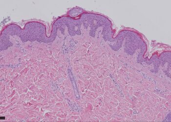 Contro il melanoma la giusta sequenza di immunoterapia e terapia molecolare