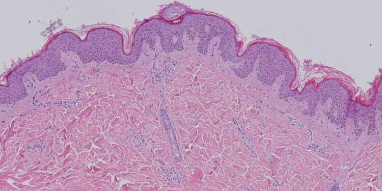 Contro il melanoma la giusta sequenza di immunoterapia e terapia molecolare