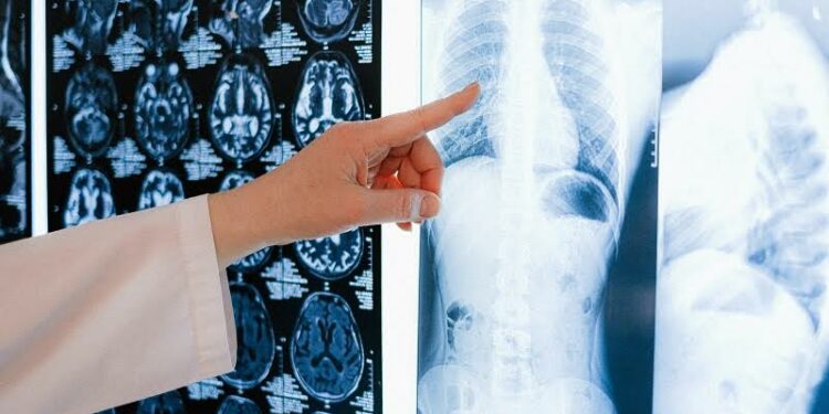 Il 15 novembre a Sassari, oncologi e specialisti si riuniscono per discutere i progressi nella diagnosi e trattamento dei tumori toraco-polmonari