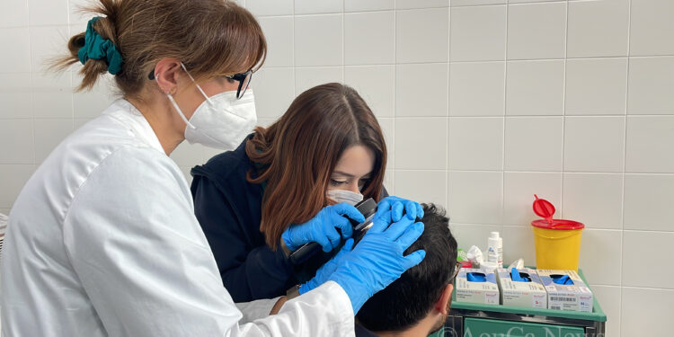Alopecia Areata Day, consulti gratuiti e senza prenotazione al San Giovanni di Dio