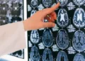 Emicrania, all’Aou di Sassari tutte le principali terapie specialistiche disponibili