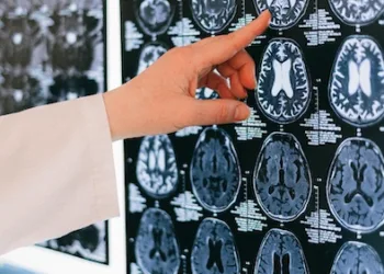 Emicrania, all’Aou di Sassari tutte le principali terapie specialistiche disponibili