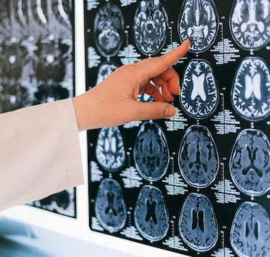 Emicrania, all’Aou di Sassari tutte le principali terapie specialistiche disponibili